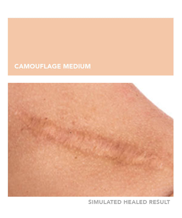 Camouflage Medium - Chanco Beauty Canada by Micro-Pigmentation Centre
